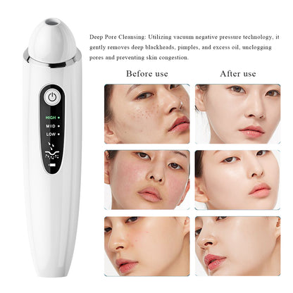 Smart Blackhead Remover Pro with Real-Time Viewing & 3 Heating Modes